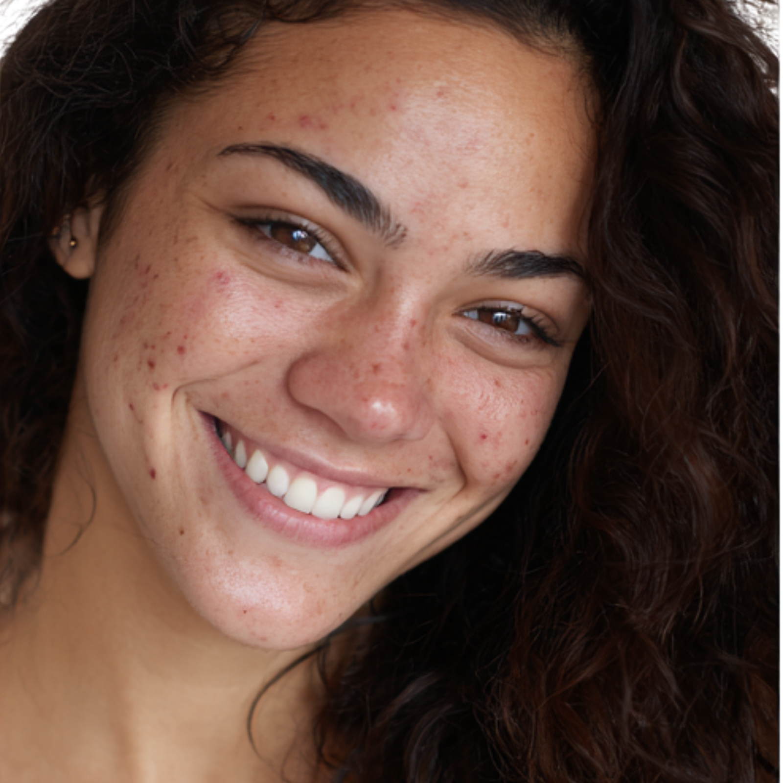 Before-and-after results showing clearer, calmer skin from sleeping on Sillo silk pillowcase a hypoallergenic, silver-ion infused, 22 Momme mulberry silk pillowcase that helps prevent acne breakouts and redness.