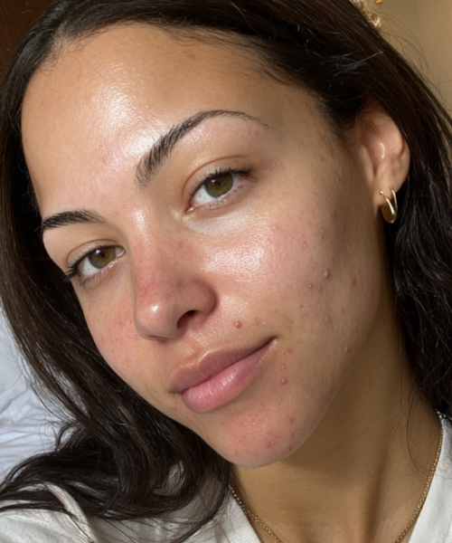 Woman with acne-prone skin who made the switch to Sillo silk pillowcase — a silver-ion infused, hypoallergenic, anti acne silk pillowcase made from 6A-grade mulberry silk that helps reduce breakouts, calm redness, and support clearer, healthier skin.